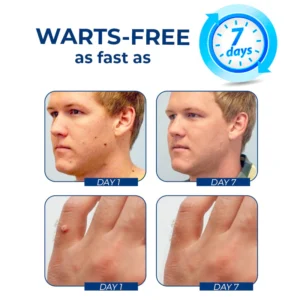 Alternative view of GFOUK™ WartsClean Spots Eradicator Cream