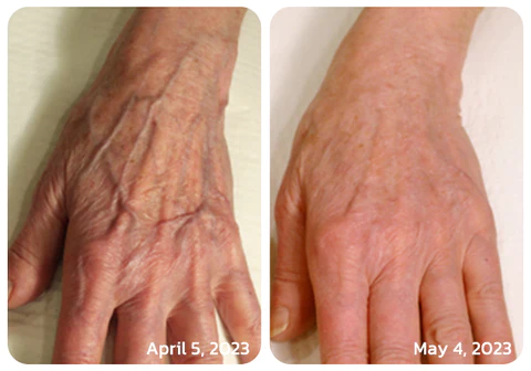 LIMETOW™ NumbFix Hands and Foots Spray