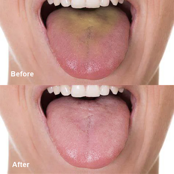 LIMETOW™ Tongue Cleaner - Image 6