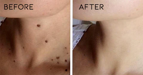 Oveallgo™ Nano-X WipeOff Tags & Moles Remover