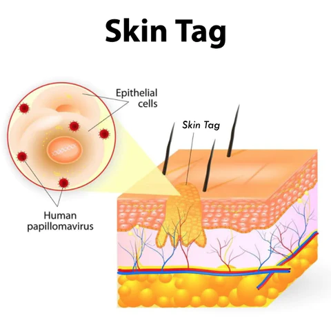 Oveallgo™ Nano-X WipeOff Tags & Moles Remover