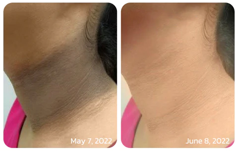 GFOUK™ FAFASKIN Back Spots And Acanthosis Nigricans Cleansing Lotion