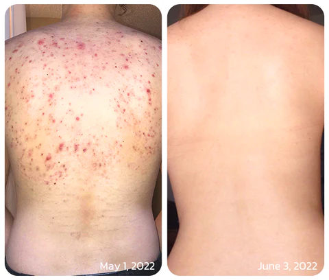 GFOUK™ FAFASKIN Back Spots And Acanthosis Nigricans Cleansing Lotion