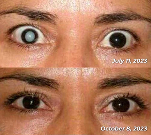 GFOUK™ OphthalPro Vision Enhancement Device