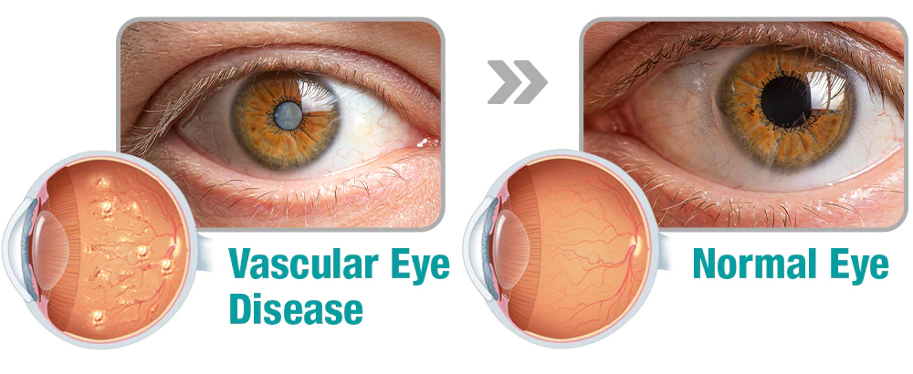 GFOUK™ OphthalPro Vision Enhancement Device