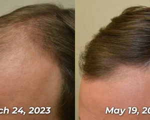 GFOUK™ PotentGRO Hair Treatment Roller