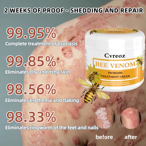 Ourlyard™ Multi-Simptom Psoriase Treatment Cream