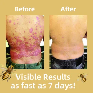 Ourlyard™ Multi-Symptom Psoriasis Treatment Cream