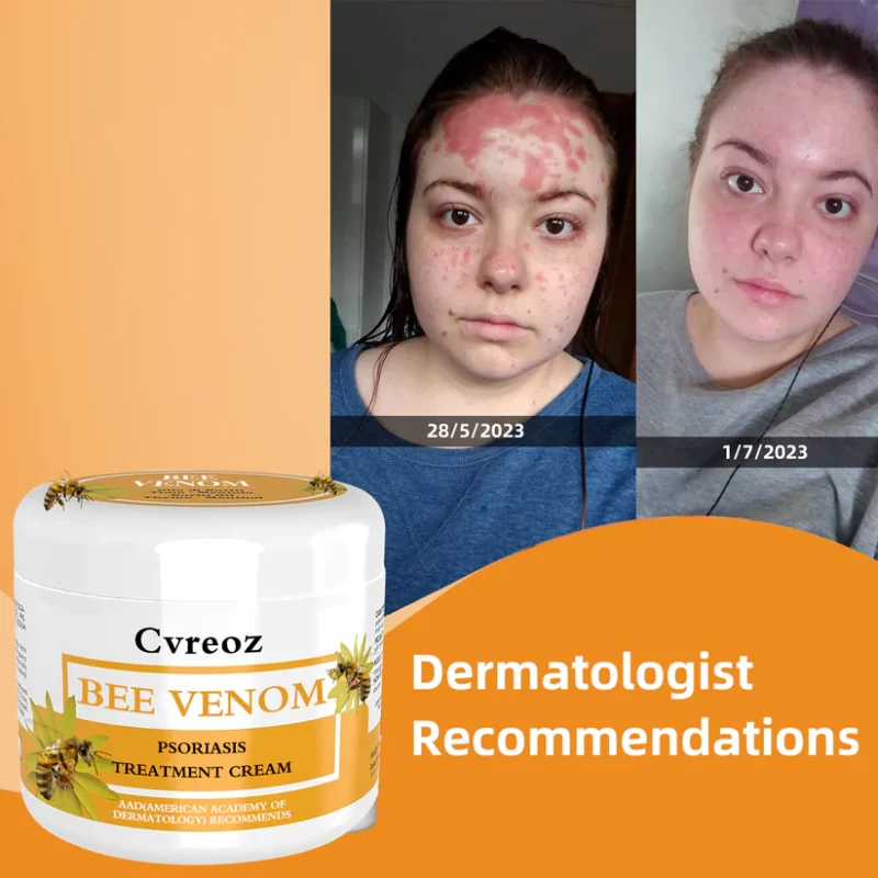 Ourlyard™ Multi-Symptom Psoriasis Treatment Cream
