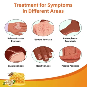 Ourlyard™ Multi-Symptom Psoriasis Treatment Cream