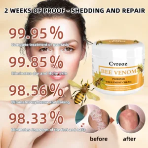 Ourlyard™ Multi-Symptom Psoriasis Treatment Cream