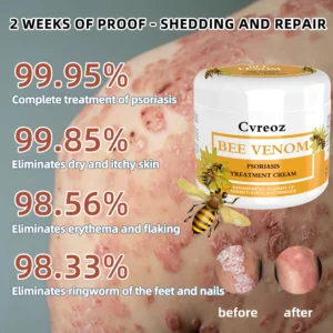 Ourlyard™ Multi-Symptom Psoriasis Treatment Cream
