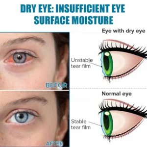 Ourlyard™ Presbyopia Vision Therapy Drops