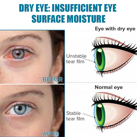 Ourlyard™ Presbyopia Vision Therapy Drops