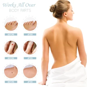 RICPIND SkinSpot Herbal Wart Remover