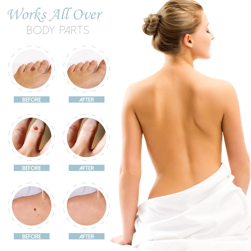RICPIND SkinSpot Herbal Wart Remover