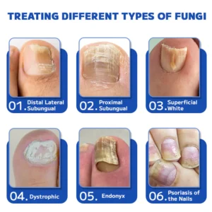 Furzero™ Fungal Nail Treatment Laser Device