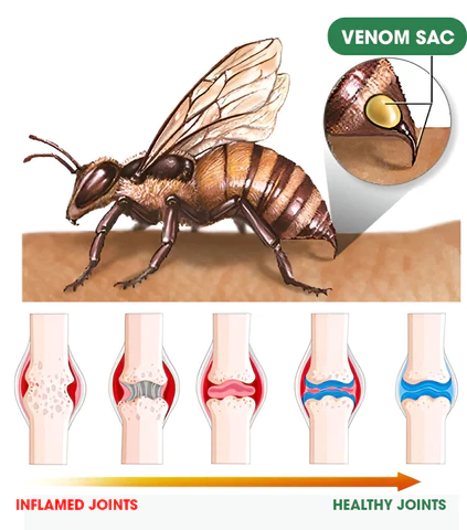 BeeZen™ Niu Sila Bee Venom Soofaatasi ma Bone Therapy Advanced Cream
