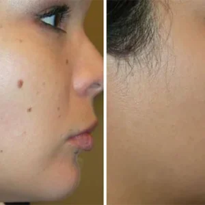 Ceoerty™ Herbal Scar-Free Acne Clear Stickers