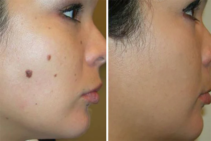 Ceoerty™ Herbal Scar-Free Acne Clear Stickers
