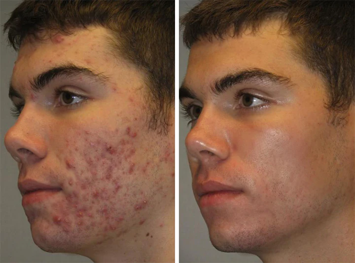 Ceoerty™ Herbal Scar-Free Acne Clear Stickers - Image 6