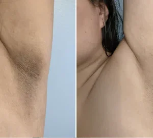 Fivfivgo™ Acanthosis Nigricans Aufhellungscreme