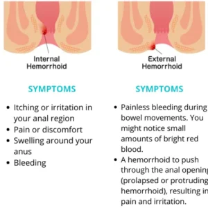 Fivfivgo™ Healmusz natürliche pflanzliche Hämorrhoidensalbe