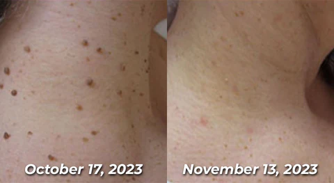 Seurico™ Bee Venom Power Mole & Wart Remover Spray