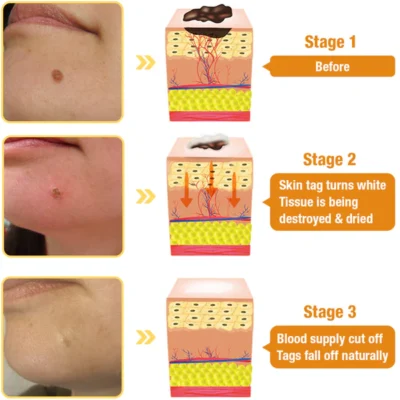 AQA™ Bee Venom Wart & Tag Removal Cream