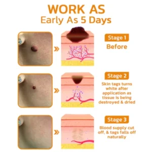 BeeGuard™ Bee Venom Mole and Wart Treatment Cream