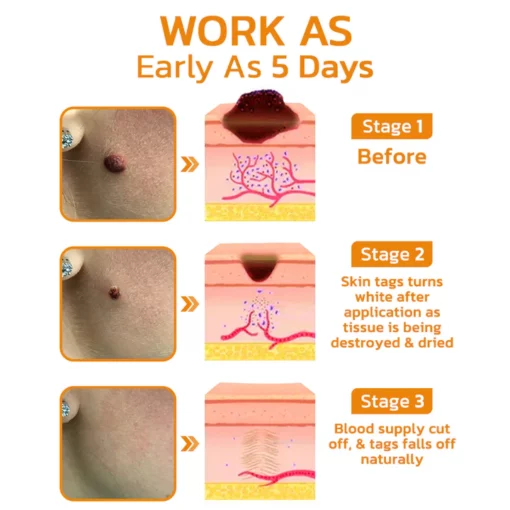 BeeGuard™ Bee Venom Mole and Wart Treatment Cream
