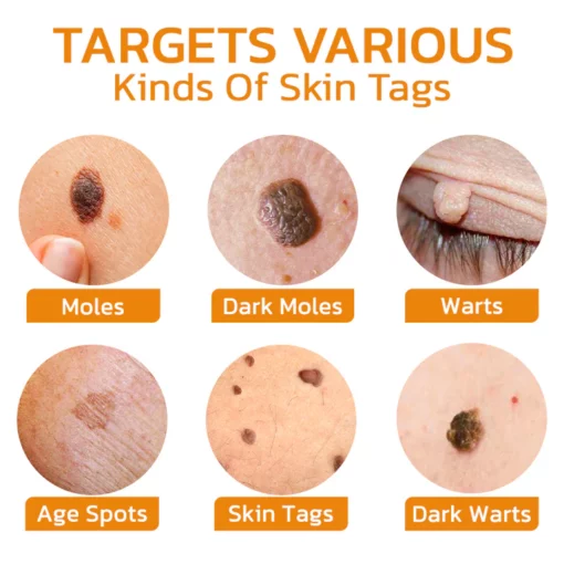 BeeGuard™ Bee Venom Mole and Wart Treatment Cream