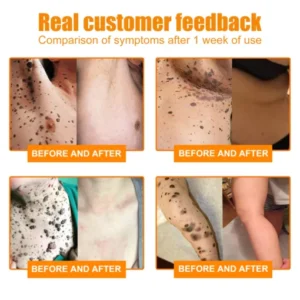 Brezey™ Bee Venom Mole and Wart Treatment Cream