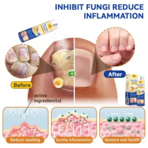 CroAie™ PsoriaHeal Bee Venom Psoriasis Treatment Spray plus