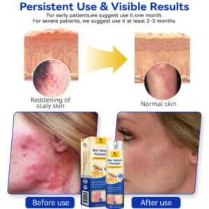 CroAie™ PsoriaHeal Bee Venom Psoriasis Treatment Spray plus