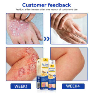 CroAie™ PsoriaHeal Bee Venom Psoriasis Treatment Spray plus