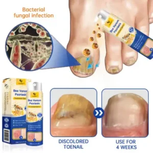 CroAie™ PsoriaHeal Bee Venom Psoriasis Treatment Spray plus