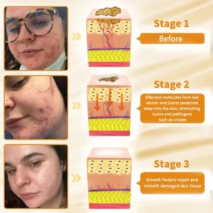 Cvreoz™ Natural Bee Venom Skin Disease Treatment Cream
