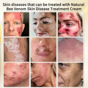 Cvreoz™ Natural Bee Venom Skin Disease Treatment Cream