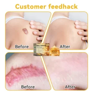 DOCTIA™ Bee Venom Medical Grade Scar Remove Advanced Gel