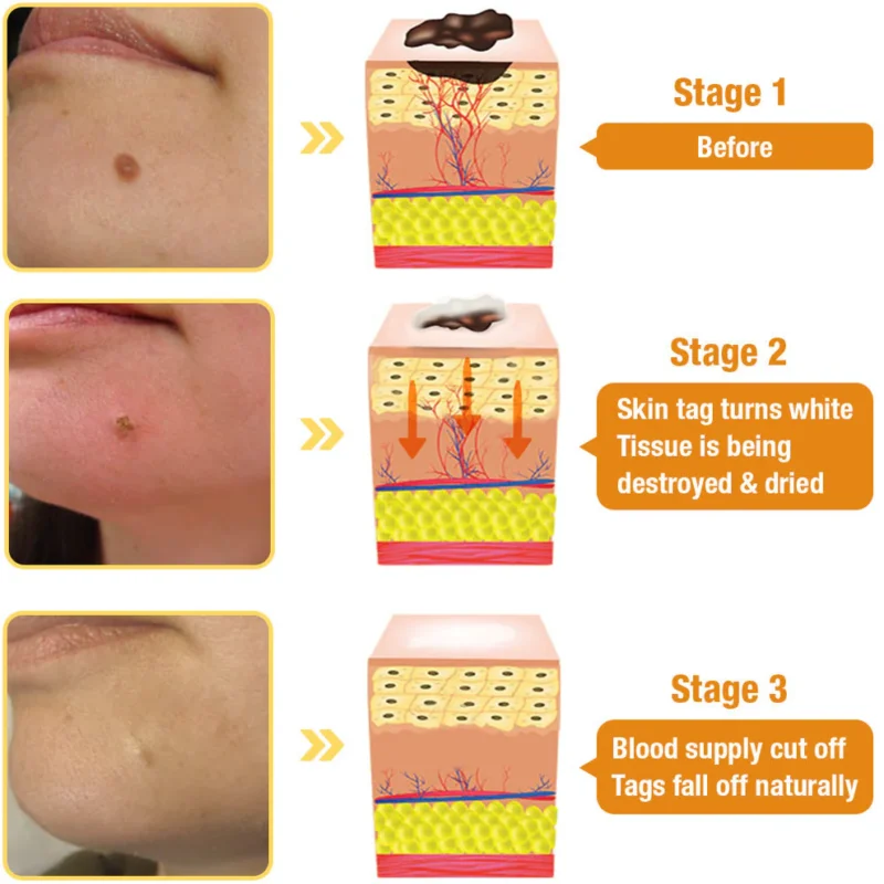 Dobshow™ Bee Venom Miracle Spray Naturally Remove Skin Tags & Warts1.webp Dobshow™ Bee Venom Miracle Spray Naturally Remove Skin Tags & Warts12.webp Dobshow™ Bee Venom Miracle Spray Naturally Remove Skin Tags & Warts13.webp Dobshow™ Bee Venom Miracle Spray Naturally Remove Skin Tags & Warts14.webp Dobshow™ Bee Venom Miracle Spray Naturally Remove Skin Tags & Warts15.webp