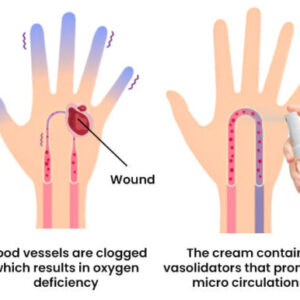 FLYCARE™ Fast Diabetic Wounds Healing Spray