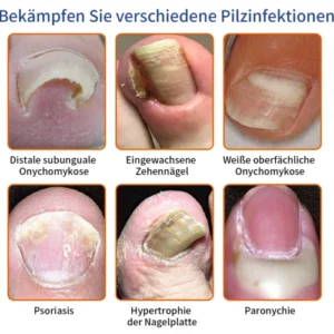 Furzero™ Bienengift Nagelpilz Behandlungslösung