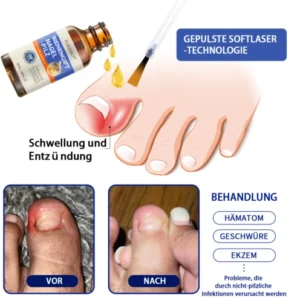 Furzero™ Bienengift Nagelpilz Behandlungslösung