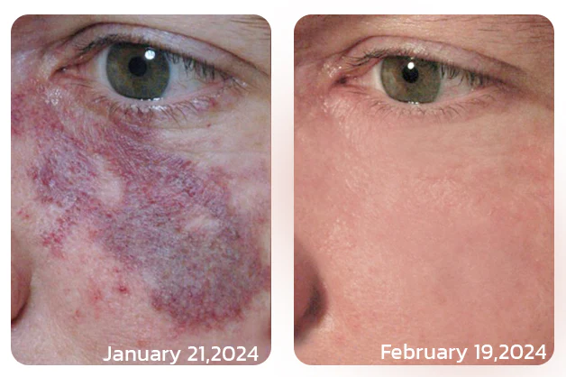 Furzero™ NonSpot Bee Venom Pigment Correction Cream