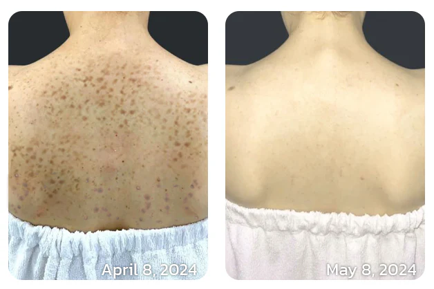 Furzero™ NonSpot Bee Venom Pigment Correction Cream
