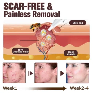 Furzero™ TagFree And Moles Remover