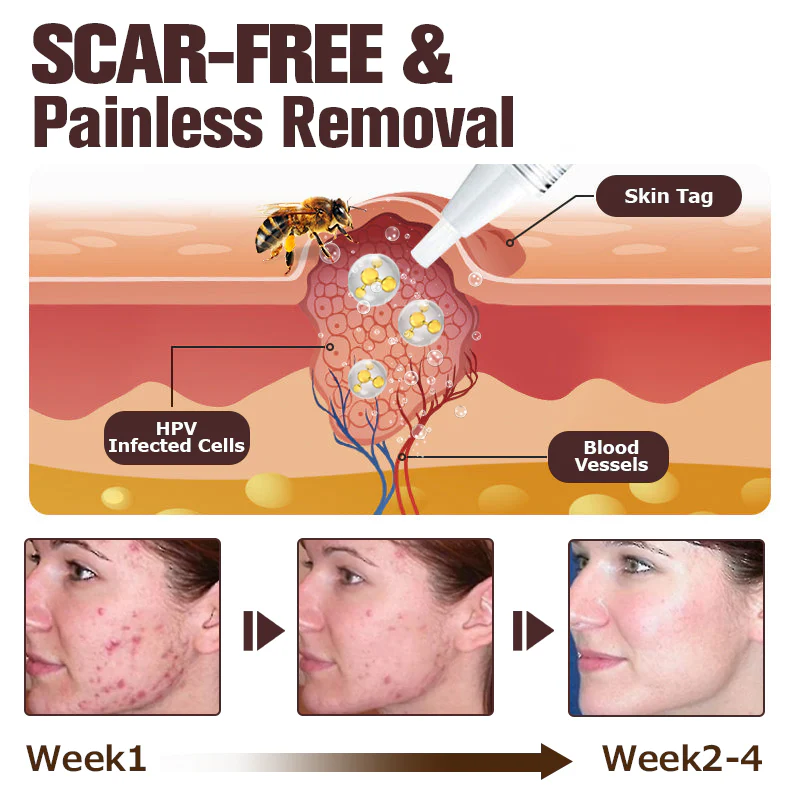 Furzero™ TagFree And Moles Remover