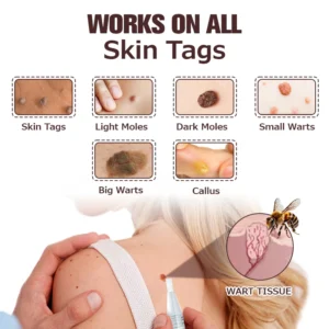 Furzero™ TagFree And Moles Remover