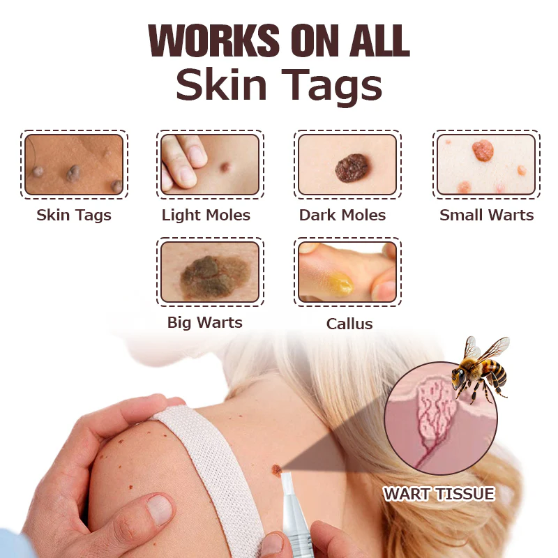 Furzero™ TagFree And Moles Remover